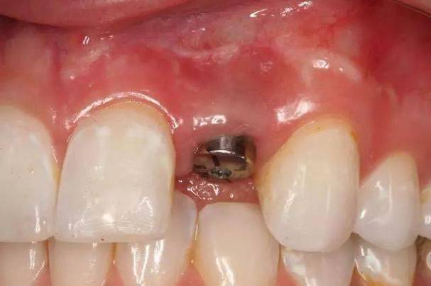 种牙会死人吗？种植牙死亡风险究竟存在吗？-图1