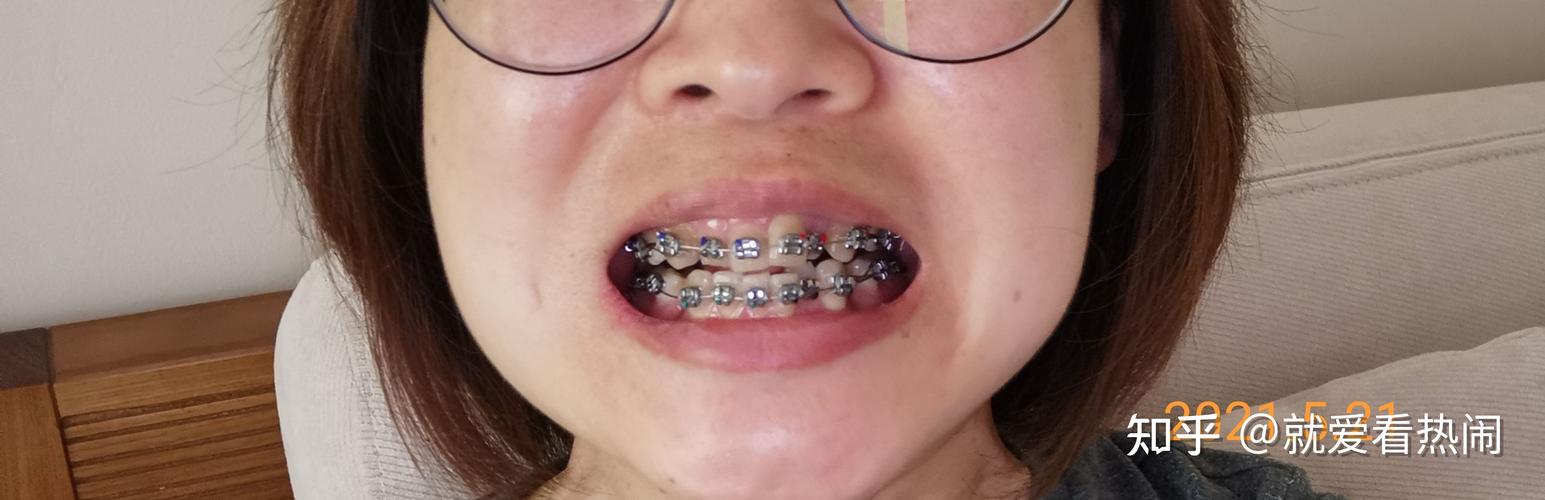 北大口腔正畸后失败-图2