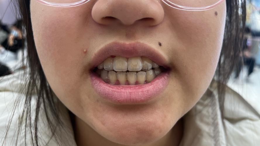 北大口腔正畸后失败-图1