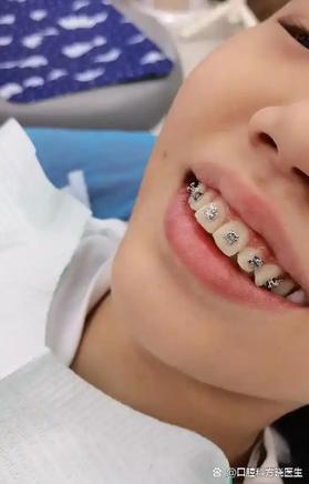 装了假牙能不能正畸-图3