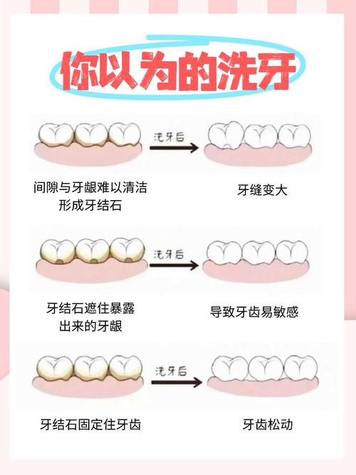 洗牙有多少种-图1
