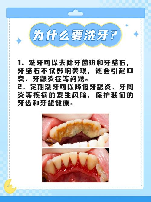 洗牙有多少种-图2