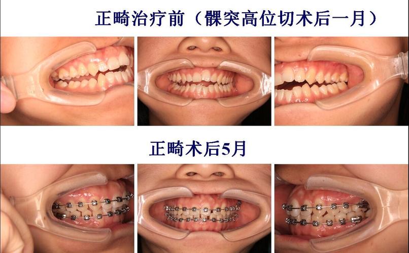 髁突吸收怎么做正畸-图2