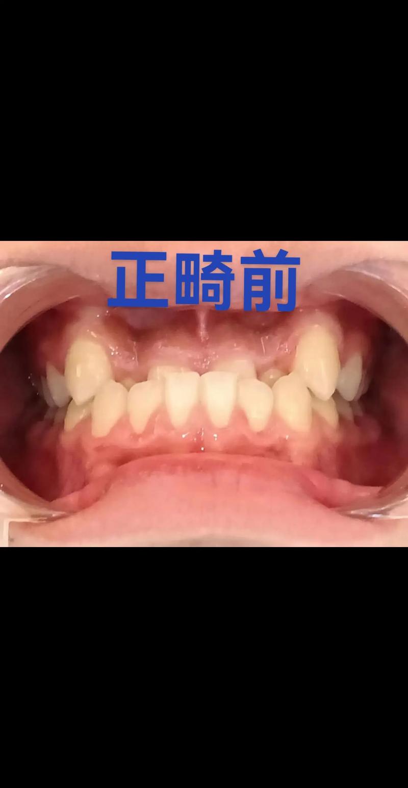 正畸下牙列整体前移,效果如何?风险可控吗?-图1 正畸下牙列整体前移,效果如何?风险可控吗?-图1