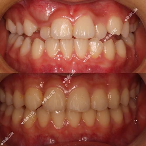 正畸下牙列整体前移,效果如何?风险可控吗?-图2 正畸下牙列整体前移,效果如何?风险可控吗?-图2