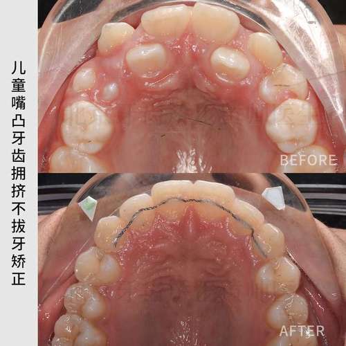 正畸后牙外展弯图片-图1