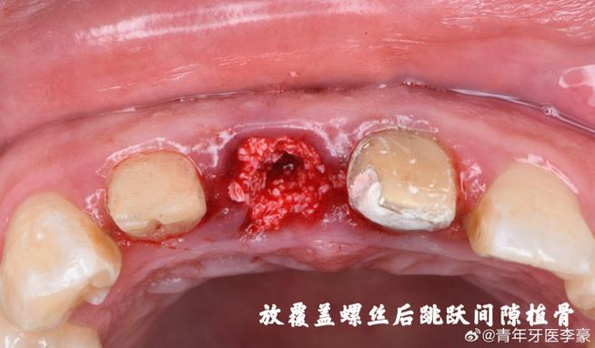 种牙植骨失败-图3