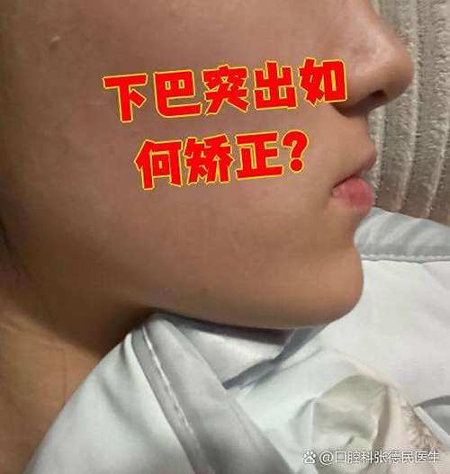 下颌偏移正畸可以吗-图3