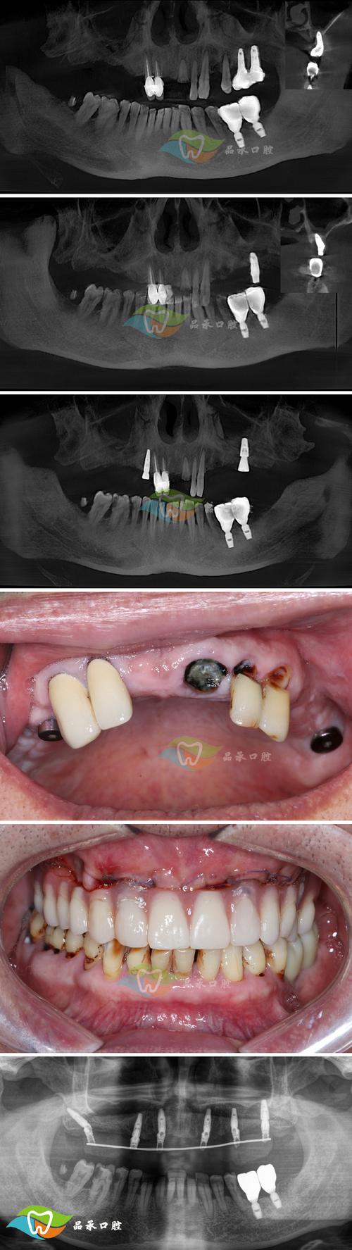 种牙骨粉吸收-图1