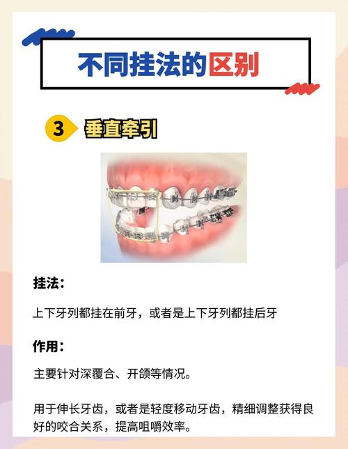 正畸牵引圈挂法分类-图3