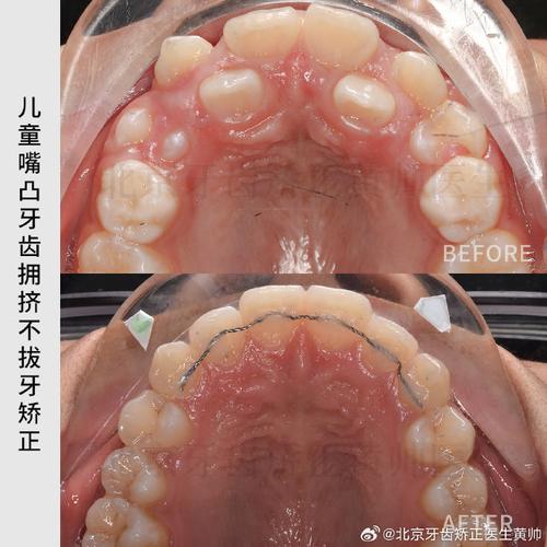 儿童6龄齿拔除正畸-图3