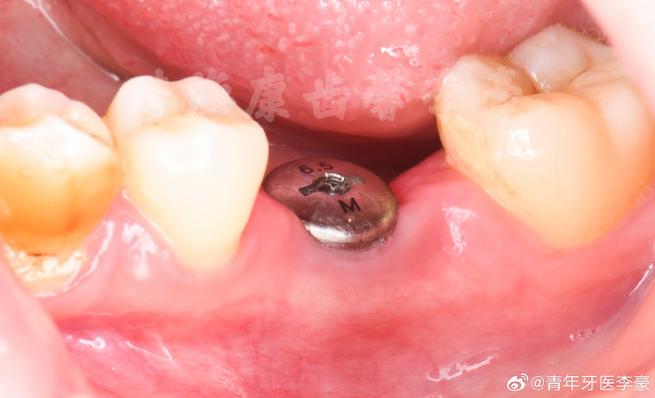 种牙感染症状-图3