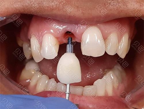 门牙种牙图片-图2 门牙种牙图片-图2
