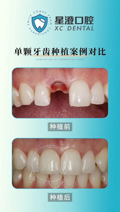 门牙种牙图片-图3 门牙种牙图片-图3