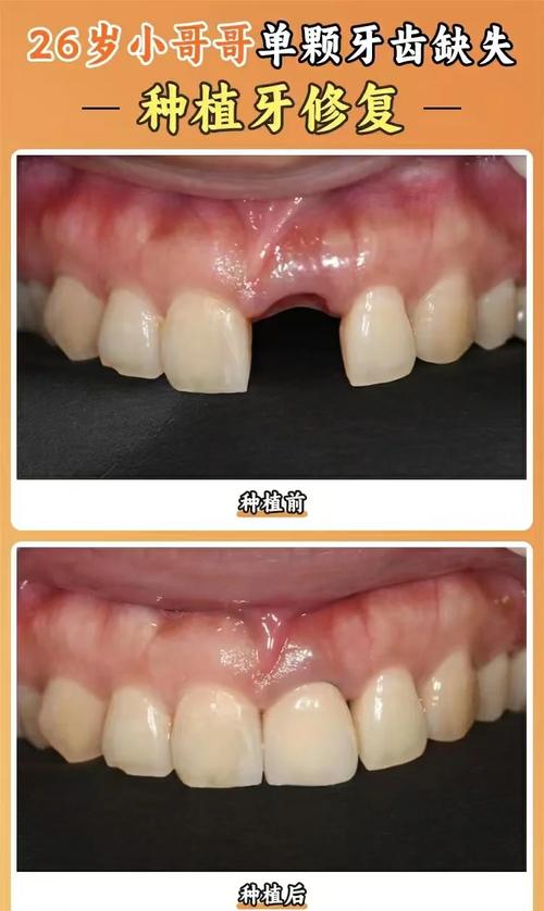 门牙种牙图片-图1 门牙种牙图片-图1