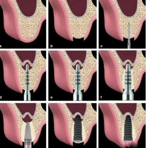 种牙怎么植骨-图3