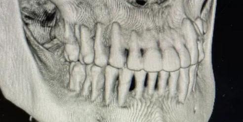 正畸牙龈骨会变薄吗-图1