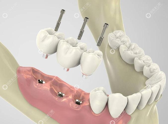 种牙安装基台-图3