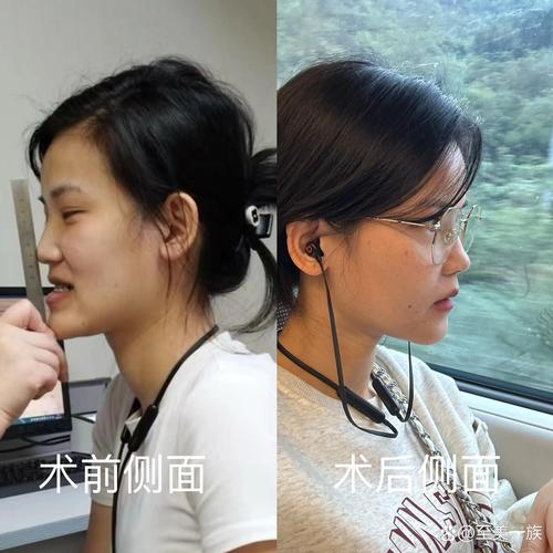 北口地包天术前正畸-图3