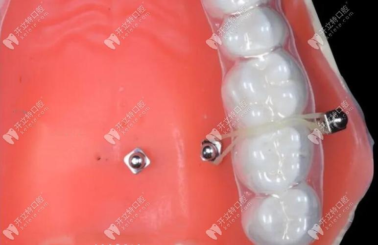 正畸牙钉是什么材质-图1