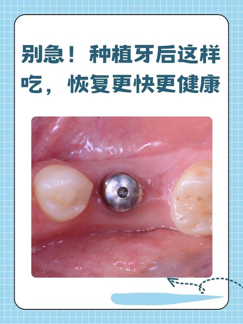 拔牙后种牙,何时种最合适?效果如何?-图2 拔牙后种牙,何时种最合适?效果如何?-图2