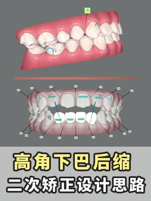 为什么隐适美正畸容易反弹？-图3