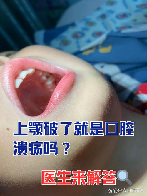 牙齿正畸期间口腔溃疡频发,该如何有效应对?-图2 牙齿正畸期间口腔溃疡频发,该如何有效应对?-图2