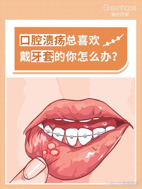 牙齿正畸期间口腔溃疡频发,该如何有效应对?-图3 牙齿正畸期间口腔溃疡频发,该如何有效应对?-图3