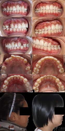 曾祥龙正畸视频直播有哪些正畸干货必看？-图3