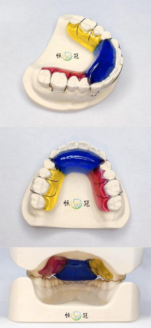 正畸牙齿平导的图片-图1