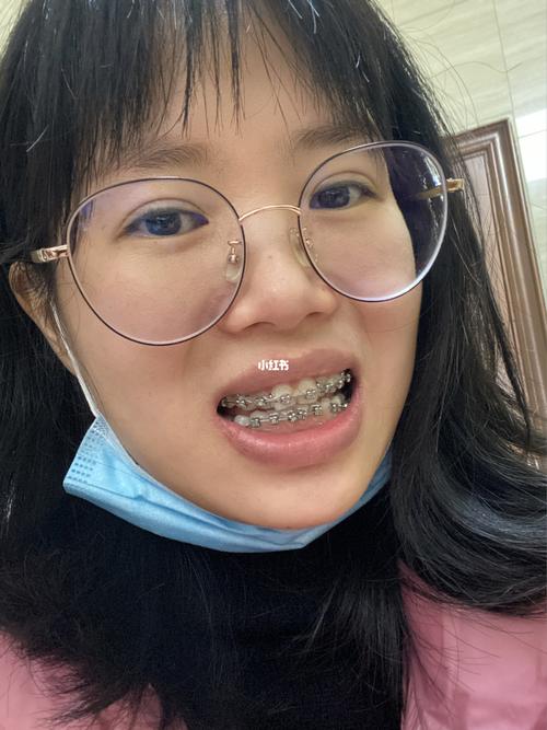 正畸牙齿平导的图片-图3