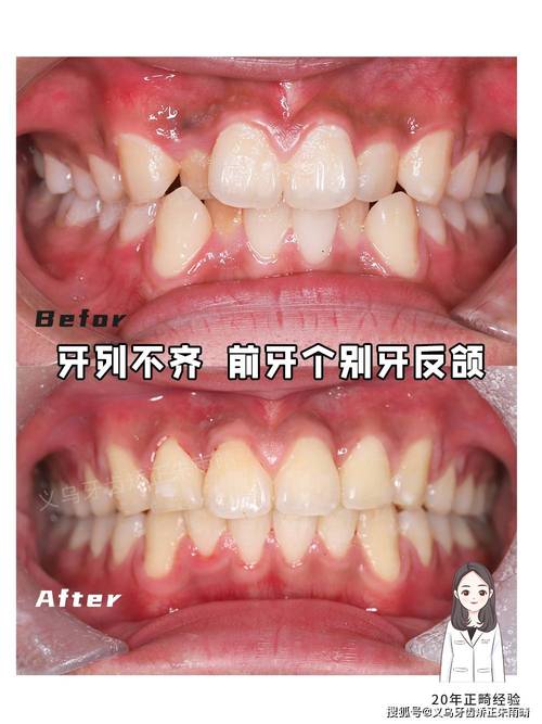 牙齿正畸门牙缝歪了-图3