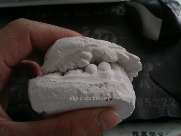 正畸后石膏模型到底有什么用？对牙齿维护和美观有何帮助？-图2