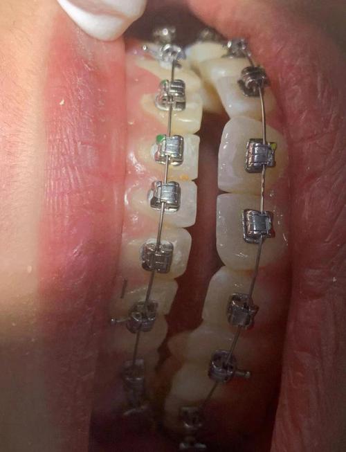 正畸游离牵引钩视频-图3