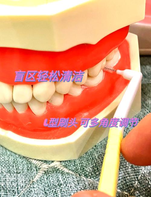 正畸粘合剂为何必须彻底清理干净?-图3 正畸粘合剂为何必须彻底清理干净?-图3