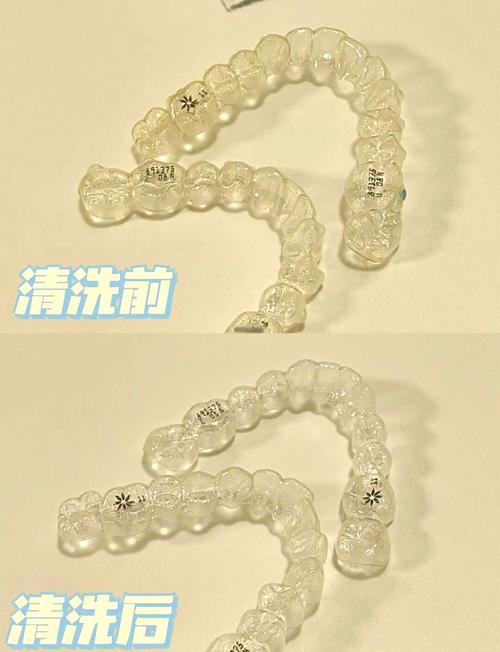 正畸粘合剂为何必须彻底清理干净?-图2 正畸粘合剂为何必须彻底清理干净?-图2