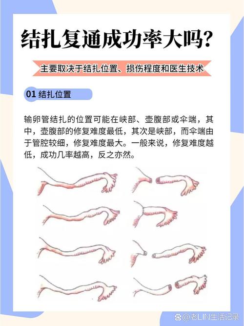 正畸8字结扎的手法-图2