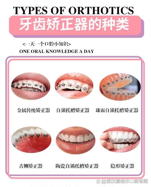 正畸锁合需要的材料-图3