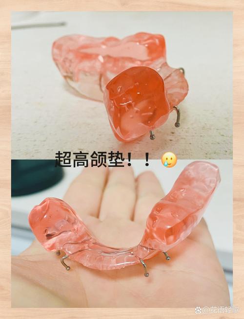 正畸锁合需要的材料-图1