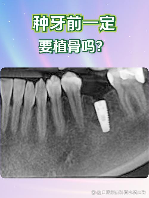 牙槽骨的植骨效果段君兰-图1