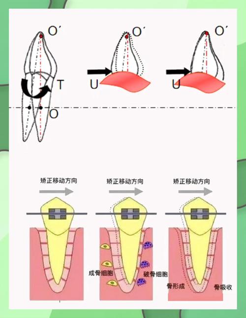 正畸t形关闭曲原理-图2