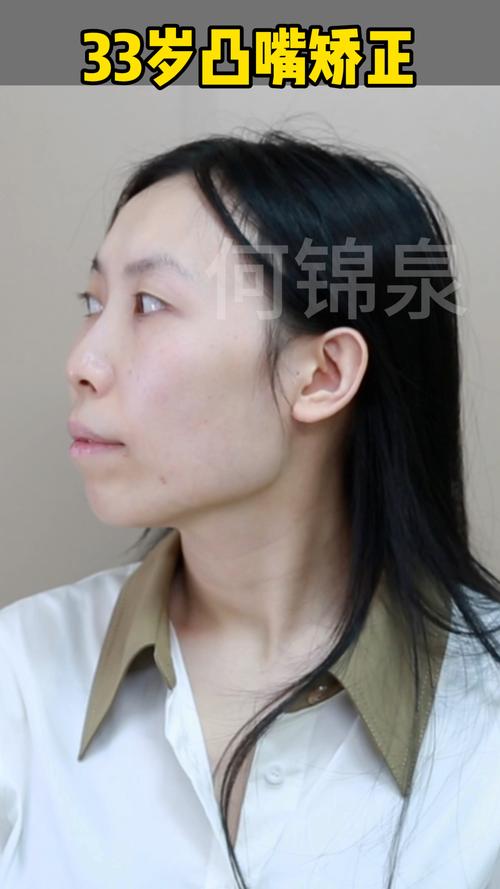 正畸后会影响正颌治疗吗？真的做不了正颌手术吗？-图1