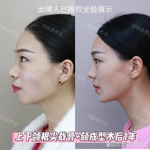 正畸后会影响正颌治疗吗？真的做不了正颌手术吗？-图2