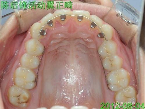 舌侧隐形微正畸技术-图1