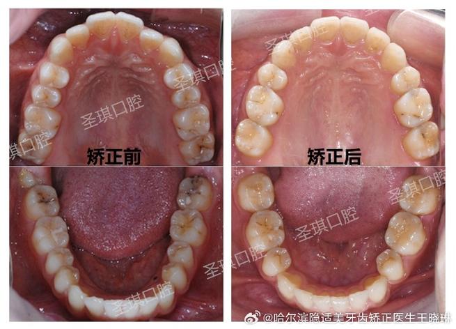 正畸牙弓拥挤9mm-图3