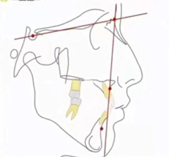正畸头侧测量数据图的核心数据如何指导正畸方案？-图2