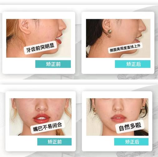 过小牙正畸要拔了吗-图1