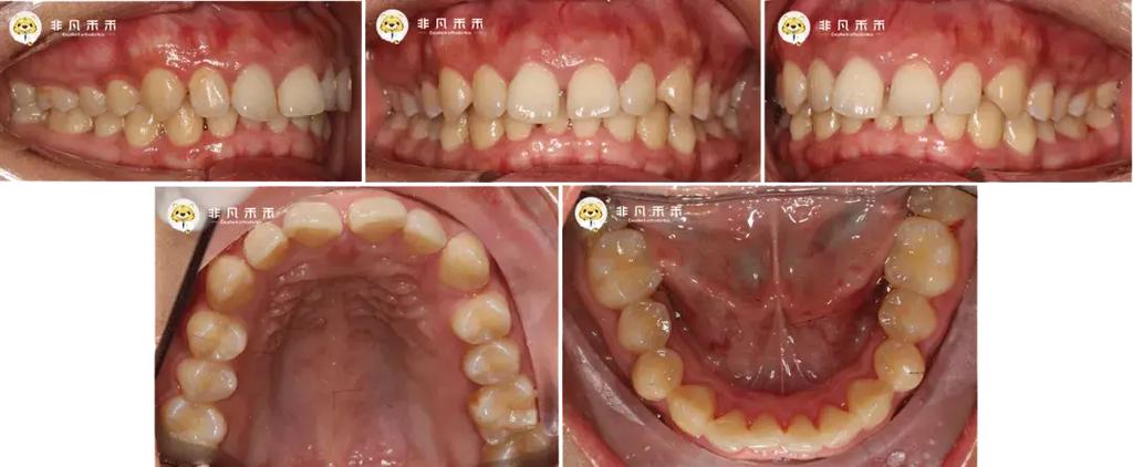 正畸不拔牙效果真的好吗？病例展示详解适用情况与效果对比-图1