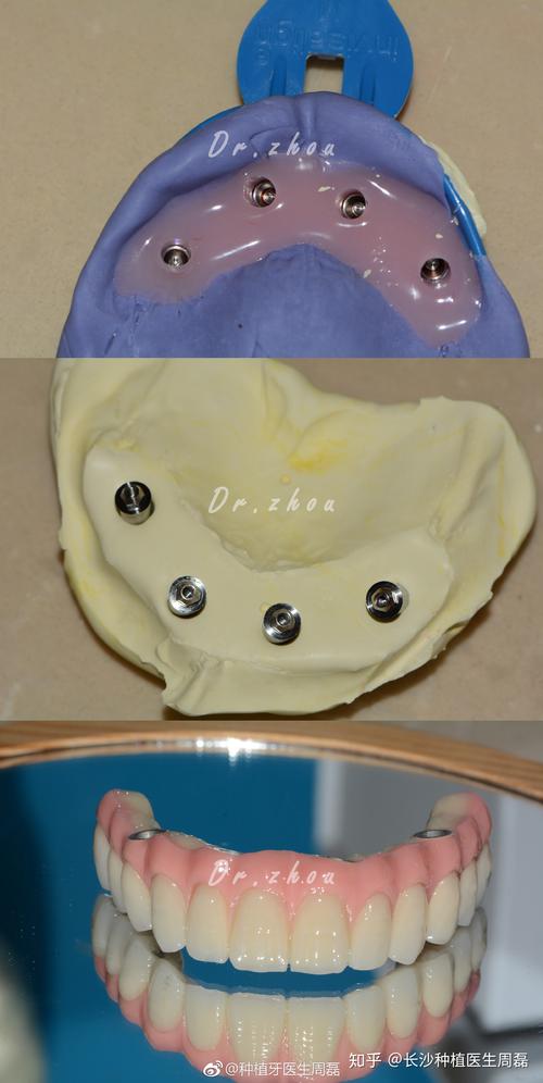 allon4种植牙全口-图3