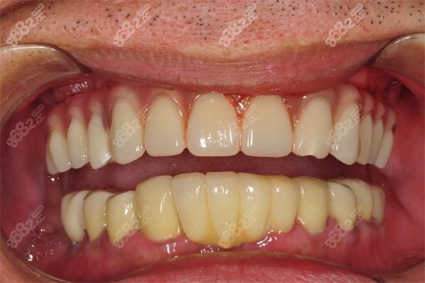 allon4种植牙全口-图2